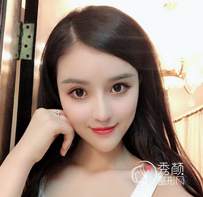 上海华美李健自体脂肪填充+隆鼻案例。