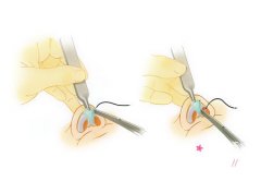 <b>隆鼻——肋软骨好还是耳软骨好?</b>