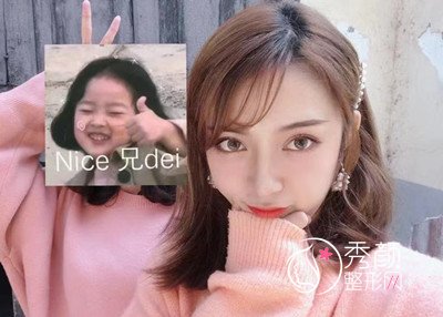 成都娇点鼻部手术隆鼻案例。