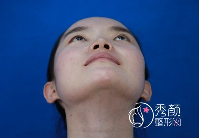 长沙爱思特肋软骨鼻部手术案例。