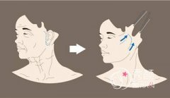 <b>面部除皱：埋线提升悬吊、“大拉皮”和“小拉皮”</b>