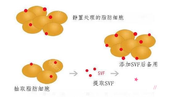 北京京韩SVF活细胞面雕和隆胸价格表