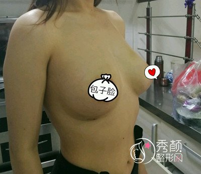北京八大处杨增杰自体脂肪隆胸案例。