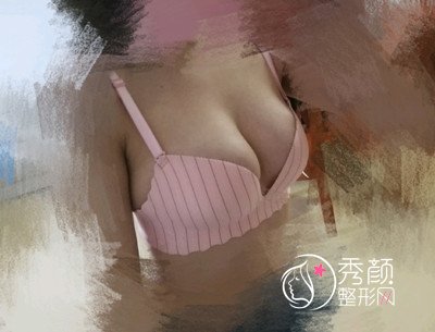 北京八大处杨增杰自体脂肪隆胸案例。