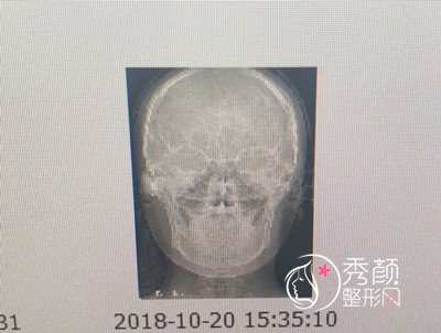 上海首尔丽格崔荣达颧骨颧弓和下颌角整形案例