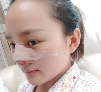 北京美莱肋软骨鼻部手术案例。