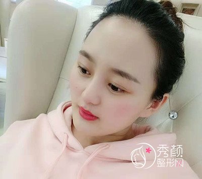 北京美莱肋软骨鼻部手术案例。