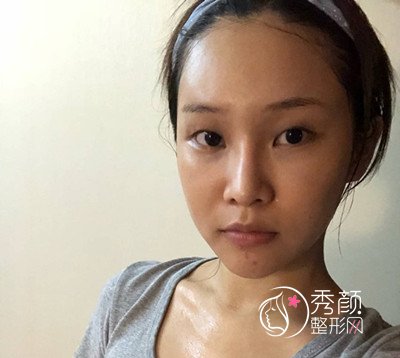 上海薇琳张怀军眼部手术案例。
