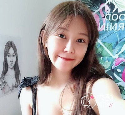 上海薇琳张怀军眼部手术案例。