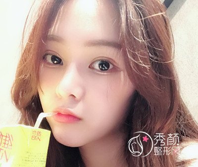 上海薇琳张怀军眼部手术案例。