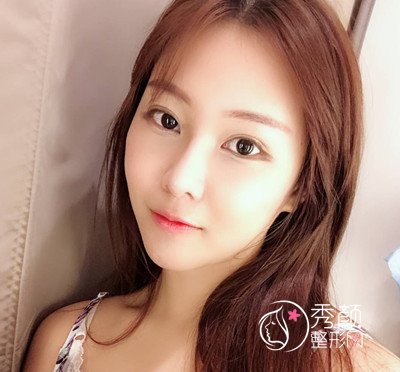 上海薇琳张怀军眼部手术案例。