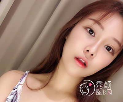 上海薇琳张怀军眼部手术案例。