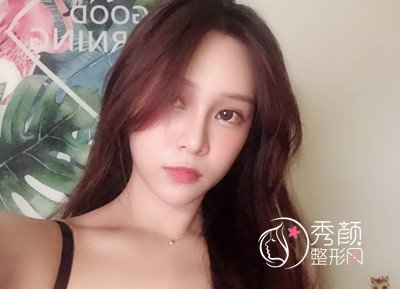 上海薇琳张怀军眼部手术案例。