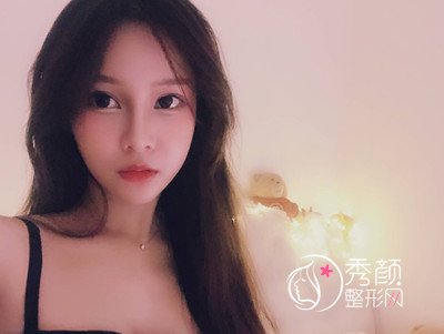上海薇琳张怀军眼部手术案例。