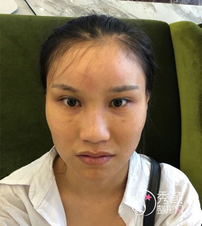 上海华美李志海颧骨内推和削下颌角案例