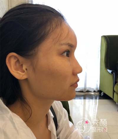 上海华美李志海颧骨内推和削下颌角案例