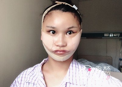 上海华美李志海颧骨内推和削下颌角案例