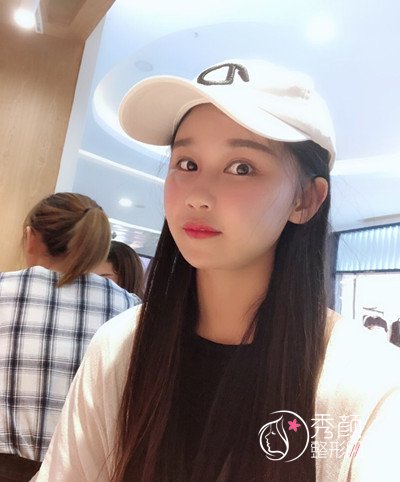 上海华美李志海颧骨内推和削下颌角案例