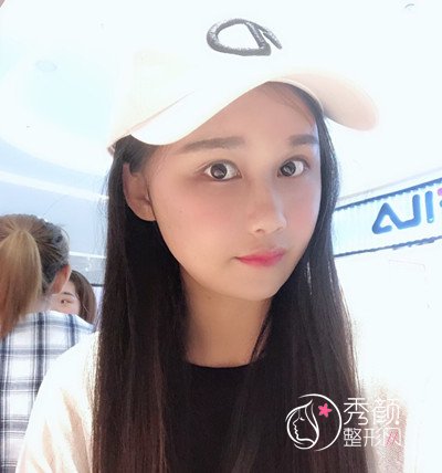 上海华美李志海颧骨内推和削下颌角案例