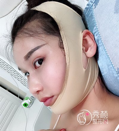 上海华美李志海颧骨内推和削下颌角案例