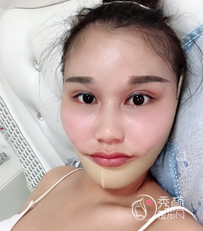 上海华美李志海颧骨内推和削下颌角案例