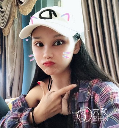 上海华美李志海颧骨内推和削下颌角案例