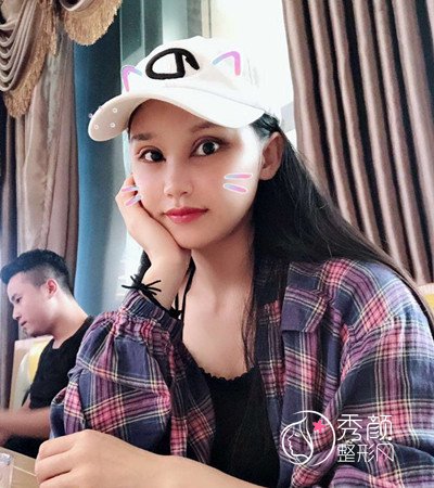 上海华美李志海颧骨内推和削下颌角案例