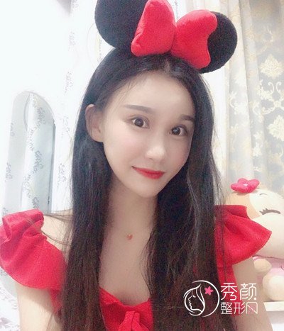 上海华美李志海颧骨内推和削下颌角案例