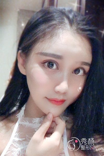 上海华美李志海颧骨内推和削下颌角案例