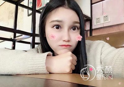 上海华美李志海颧骨内推和削下颌角案例
