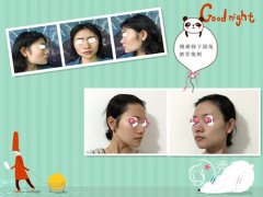 穆雄铮磨骨怎么样?有失败案例吗?
