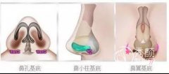<b>什么是鼻基底整形,多少钱,有没有后遗症?</b>