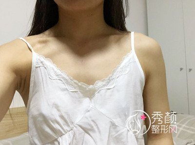 上海华美谢卫国假体隆胸（270cc麦格水滴型）案例