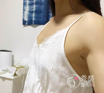 上海华美谢卫国假体隆胸(270cc麦格水滴型)案例