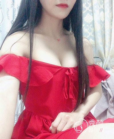 上海华美谢卫国假体隆胸(270cc麦格水滴型)案例