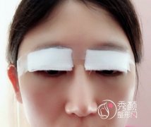 上海九院眼睑下至手术整形案例。