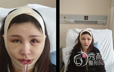 上海九院下颌角整形哪个医生好,徐梁下颌角整形