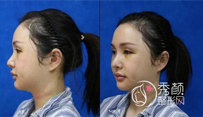 上海九院下颌角整形哪个医生好,徐梁下颌角整形