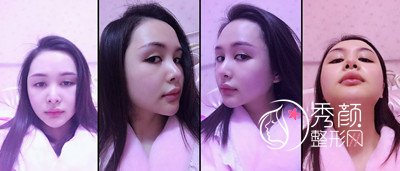 上海九院下颌角整形哪个医生好,徐梁下颌角整形
