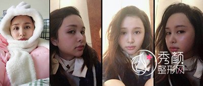 上海九院下颌角整形哪个医生好,徐梁下颌角整形