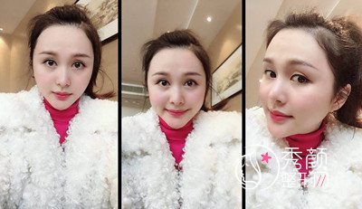 上海九院下颌角整形哪个医生好,徐梁下颌角整形