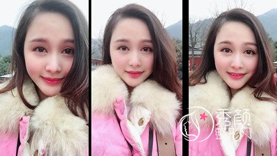 上海九院下颌角整形哪个医生好,徐梁下颌角整形