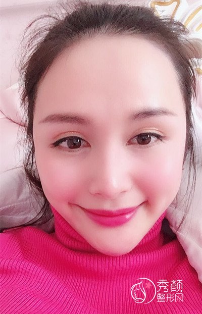 上海九院下颌角整形哪个医生好,徐梁下颌角整形