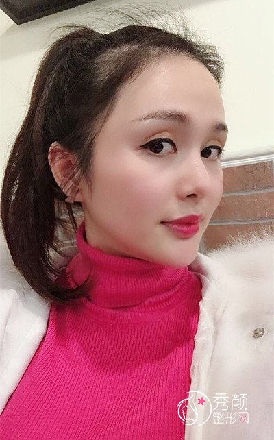 上海九院下颌角整形哪个医生好,徐梁下颌角整形