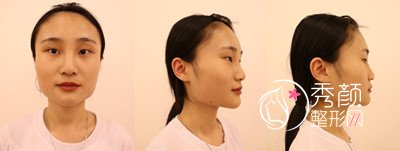 上海伊莱美李湘原下颌角整形案例。