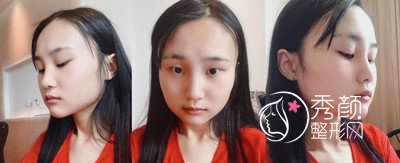 上海伊莱美李湘原下颌角整形案例。