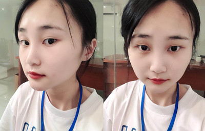 上海伊莱美李湘原下颌角整形案例。