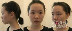 <b>上海华美徐文龙隆鼻怎么样,案例分享。</b>