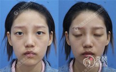 <b>上海华美许再荣割双眼皮怎么样,靠谱吗?</b>