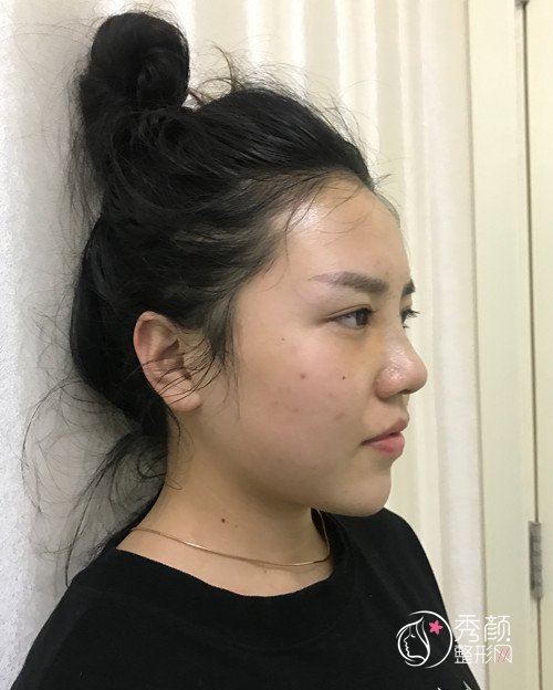北京韩啸整形门诊鼻部手术案例分享。